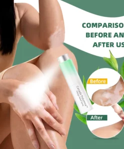Canada Polumna™ Vitiligo Relief Spray