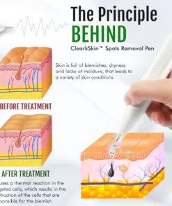 ClearSkin™ Spots Removal Pen