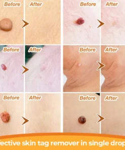 DR. Reilly™ Skin Tag Remover