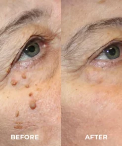 DR. Reilly™ Skin Tag Remover