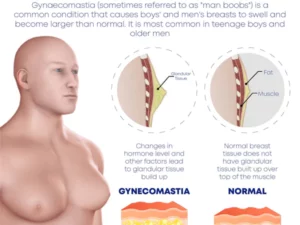 GynoBurn MenChest Sculpting Spray
