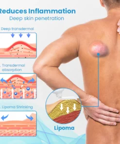 HEALumps™ Lipoma Treatment Ointment