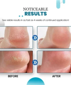 HeelHaven™ Severe Cracked Heel Balm