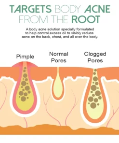 MEDCure BackAcne Removal Spray