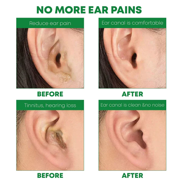 MedHealth Tinnitus EarWax Removal Kit