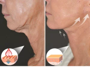 MyOeganix Radiant Lines Gone Neck-Gel