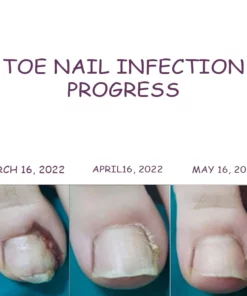 NailHeal AntiParonychia Relief Patch