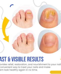 NailSpeed™ Light Cure Fungal Nail Pen