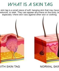 OrganicPro SkinTag FastRemover Patches