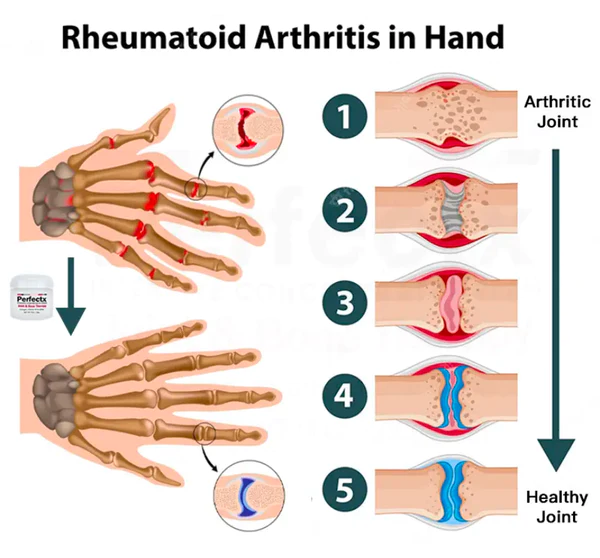 Perfeᴄtx™ जॉइंट और बोन थेरेपी क्रीम
