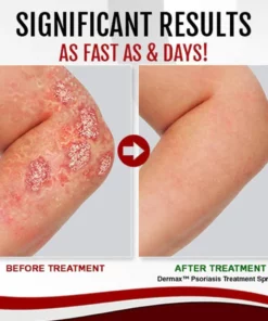 Psoriatrax Psoriasis Relief Spray