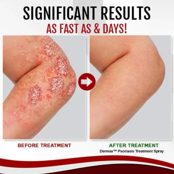 Psoriatrax Psoriasis Relief buufinta