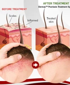 Psoriatrax Psoriasis Relief Spray
