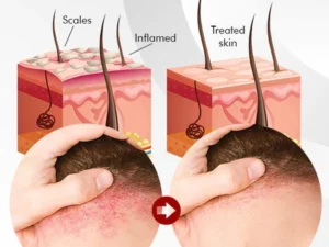 Psoriatrax Psoriasis Relief Spray