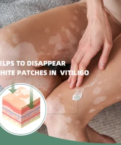 Shinyme Vitiligo Skin Repair Cream