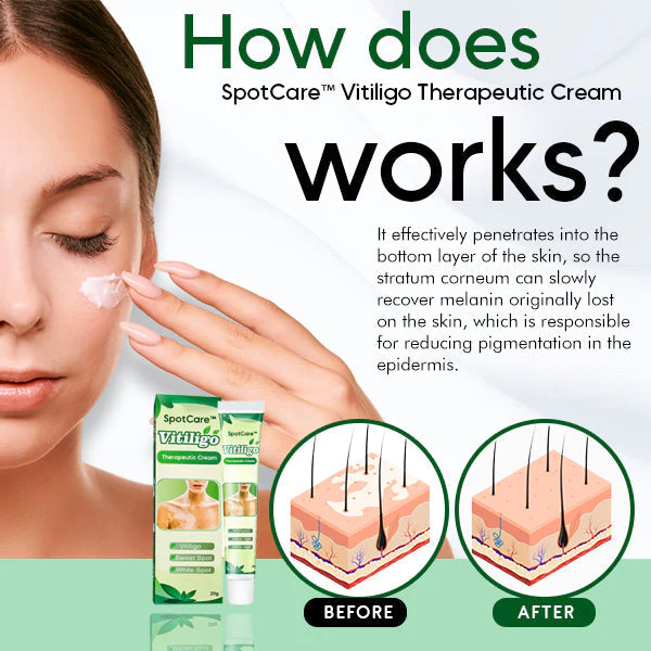 SpotCare™ Crema Terapéutica Vitiligo