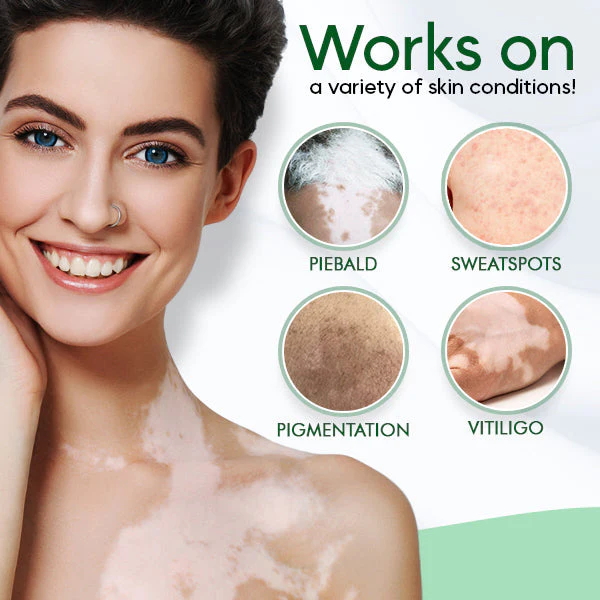 SpotCare™ Vitiligo Krema Terapewtika