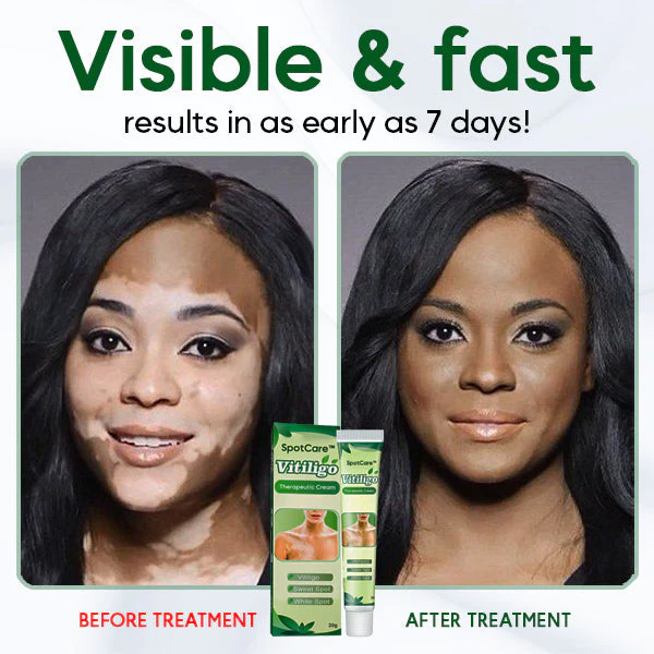 SpotCare™ Vitiligo Terapötik Krem