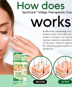 SpotCare™ Vitiligo Therapeutic Cream