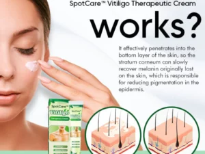 SpotCare™ Vitiligo Therapeutic Cream