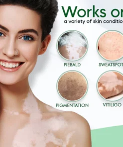 SpotCare™ Vitiligo Therapeutic Cream