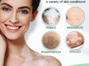 SpotCare™ Vitiligo Therapeutic Cream
