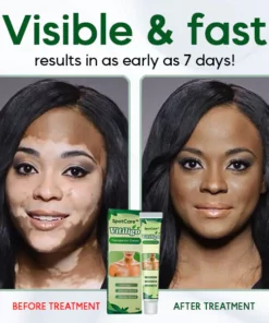 SpotCare™ Vitiligo Therapeutic Cream