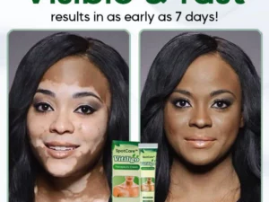 SpotCare™ Vitiligo Therapeutic Cream