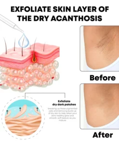 ATTDX AcanthosisNigricans Treatment Oil