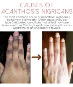 ATTDX Lightens AcanthosisNigricans TherapyOil