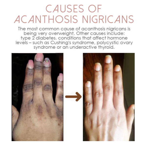 ATTDX alleggerisce l'acantosi Nigricans TherapyOil