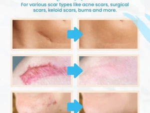 Advance Organic Scar Removing Gel