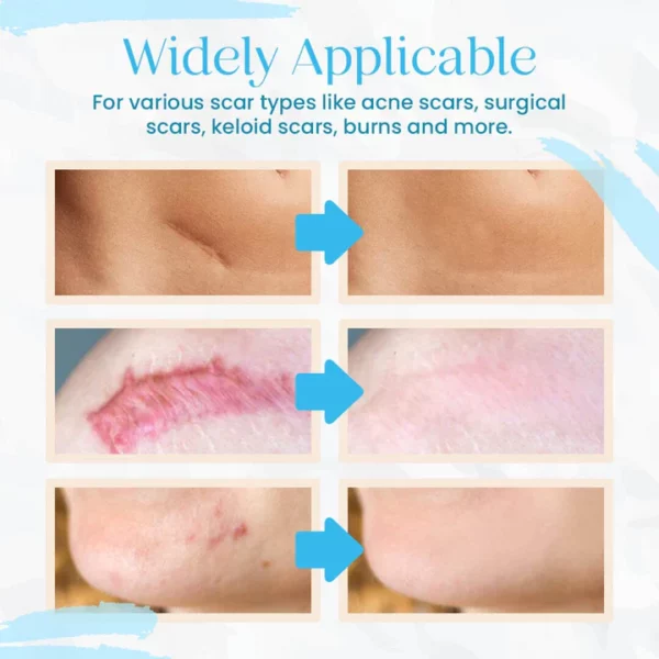 Advance Organic Scar Removal Gel