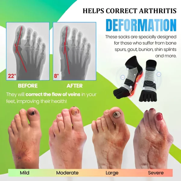 Kahortagga Arthritis Detox Tourmaline Acupressure Sock