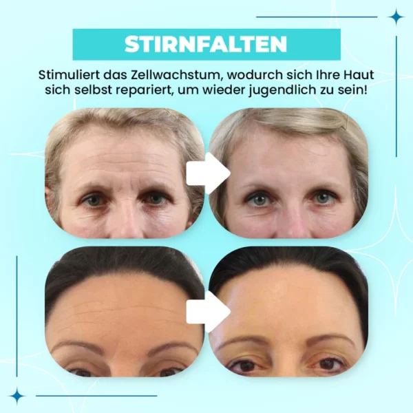 Anti-Falten-Stirnlinien-Entfernungs-Gel-Patch