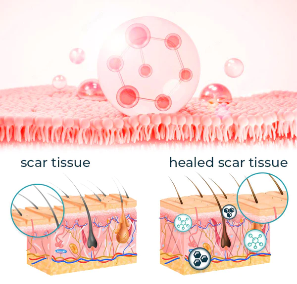 Bioskin™ Fortgeschrittenes Glóthach zur Narbenentfernung