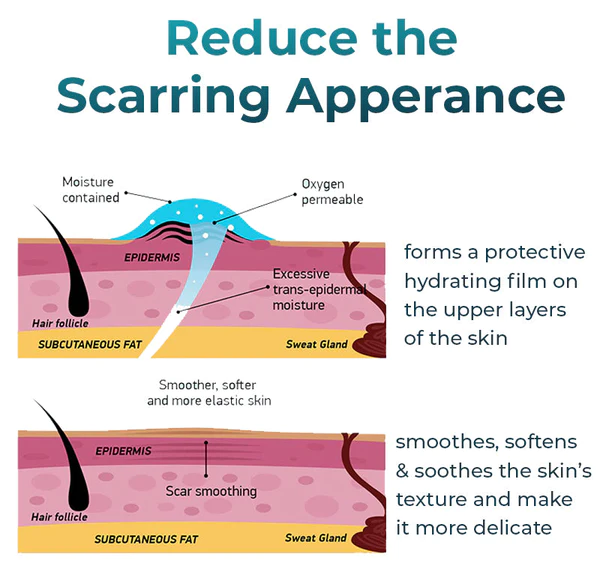 Bioskin ™ Fortgeschrittenes Gel zur Narbenentfernung