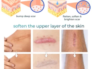 Bioskin™ Fortgeschrittenes Gel zur Narbenentfernung