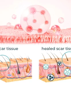 Bioskin™ Fortgeschrittenes Gel zur Narbenentfernung