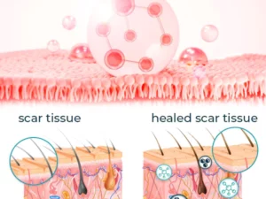 Bioskin™ Fortgeschrittenes Gel zur Narbenentfernung