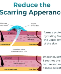 Bioskin™ Fortgeschrittenes Gel zur Narbenentfernung