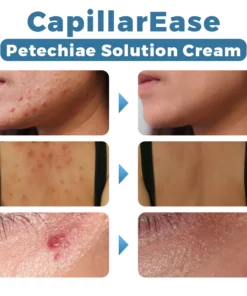 CapillarEase Petechiae Solution Cream