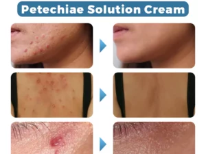 CapillarEase Petechiae Solution Cream