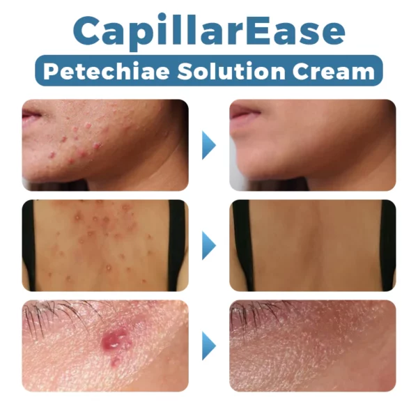 CapillarEase Petechiae Solution krema