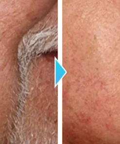 CapillarEase Petechiae Solution Cream