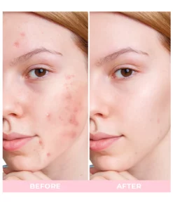 Clinical™ Blu-ray Acne Therapy Pen