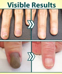 Derscour™ Anti-Fungal Treatment Nail Repair Pen