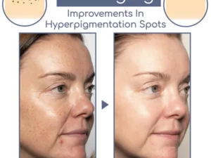ECosmea™ Needleless Firming Mask