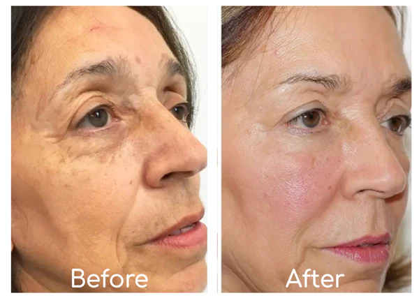 ECosmea™ Needleless Firming Mask