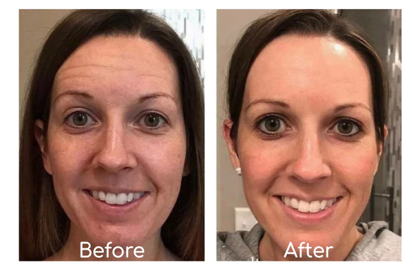 ECosmea™ Needleless Firming Mask - Image 6